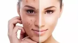 Faciales para prevenir el acné de verano