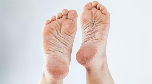 Hongos en los pies: cuáles son los síntomas y cómo evitarlos