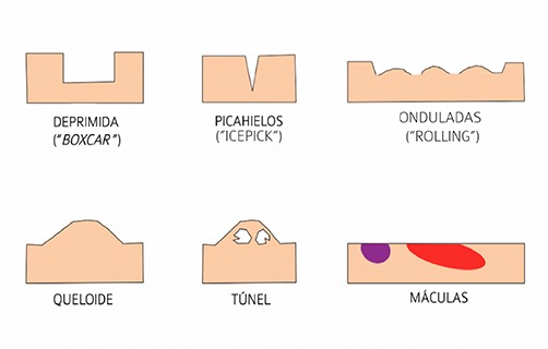 tipos-marcas-cicatrices-acne