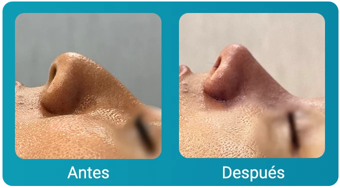 caso clinico rinoplastia 1