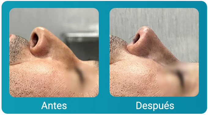 caso clinico rinoplastia 3