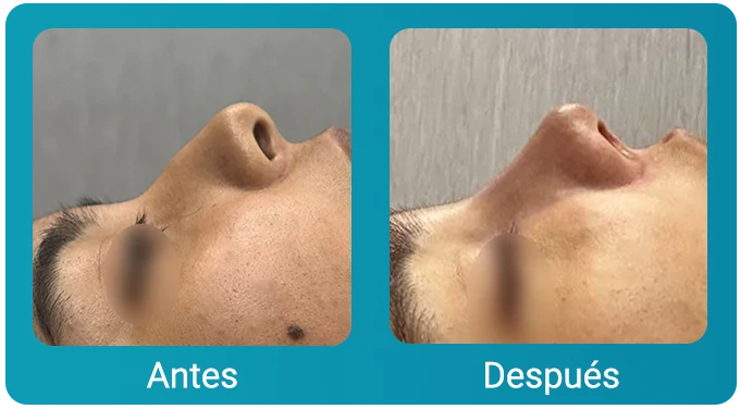 caso clinico rinoplastia 4