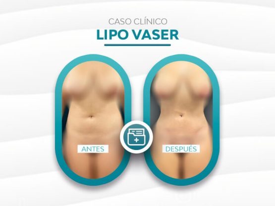 Lipovaser caso clinico